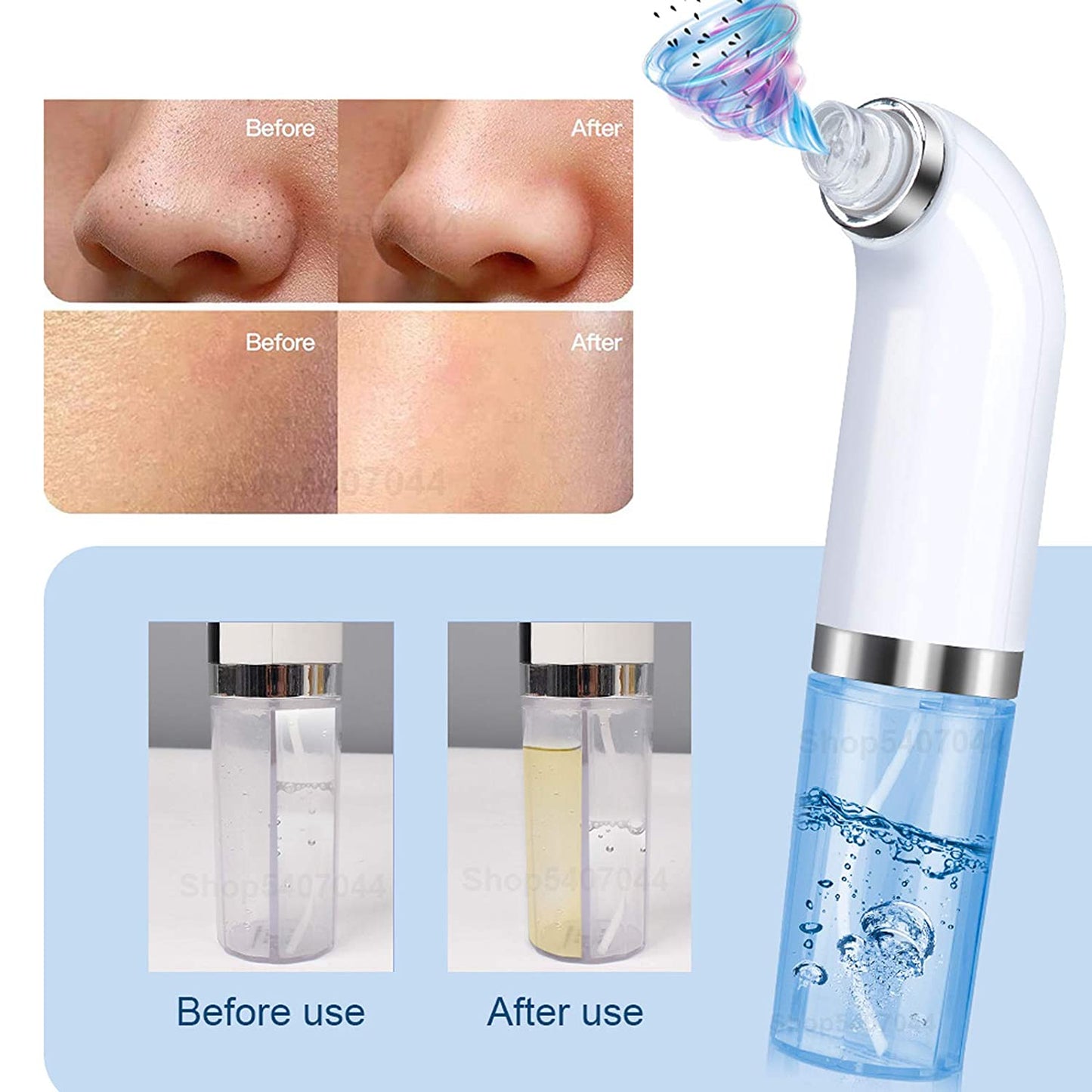 Blackhead Removal Tool